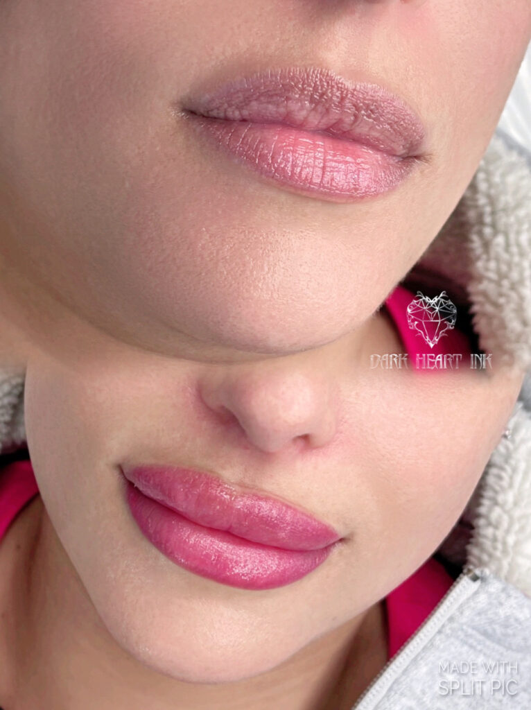 A woman's lips undergo a transformation after lip injections in the comfort of her home.